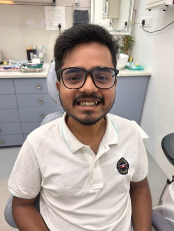 After Teeth Whitening